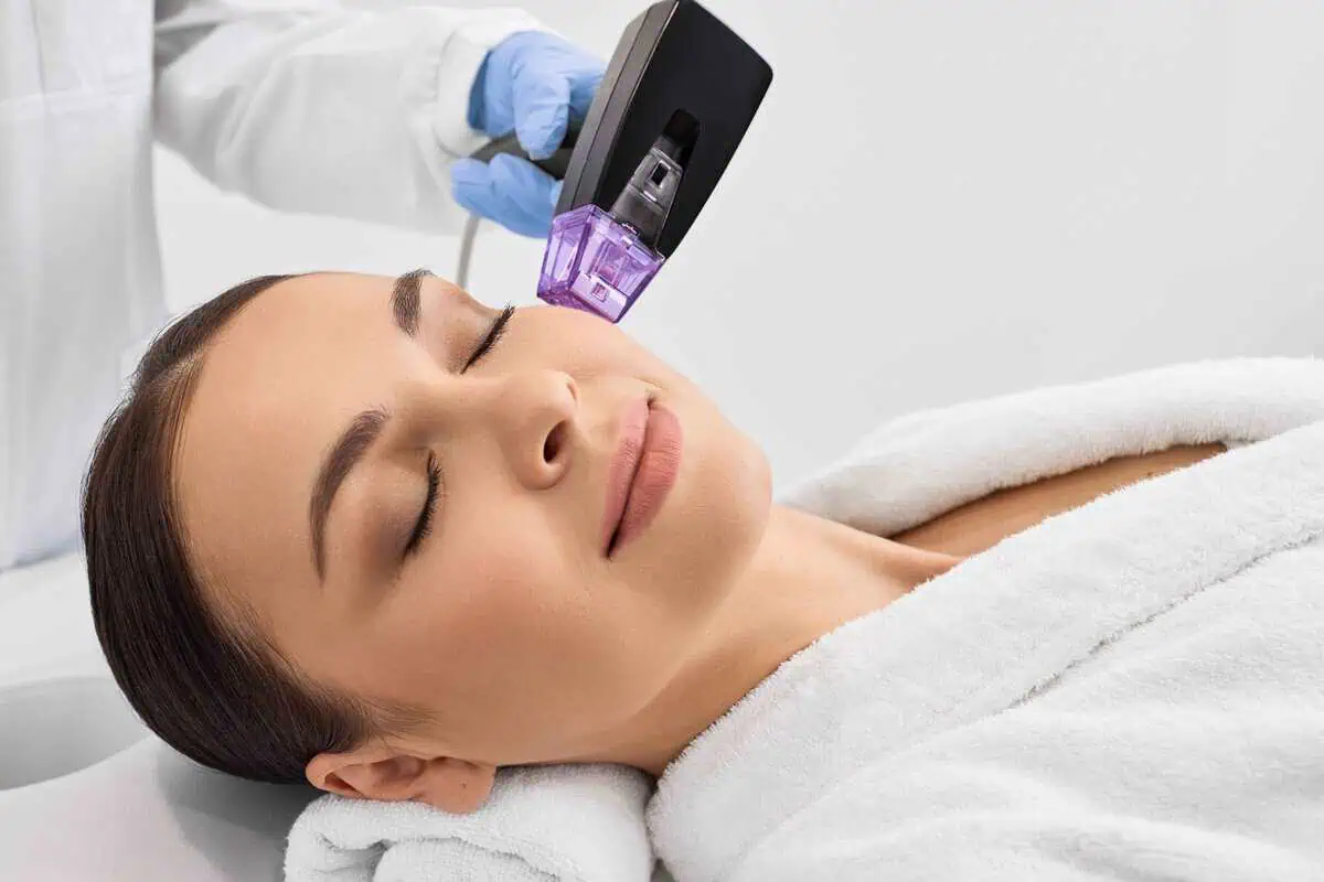 Radiofrequency Microneedling Improves Acne Scars